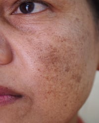 Hyperpigmentation