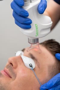 Secret PRO Fractional CO2 Laser Treatment